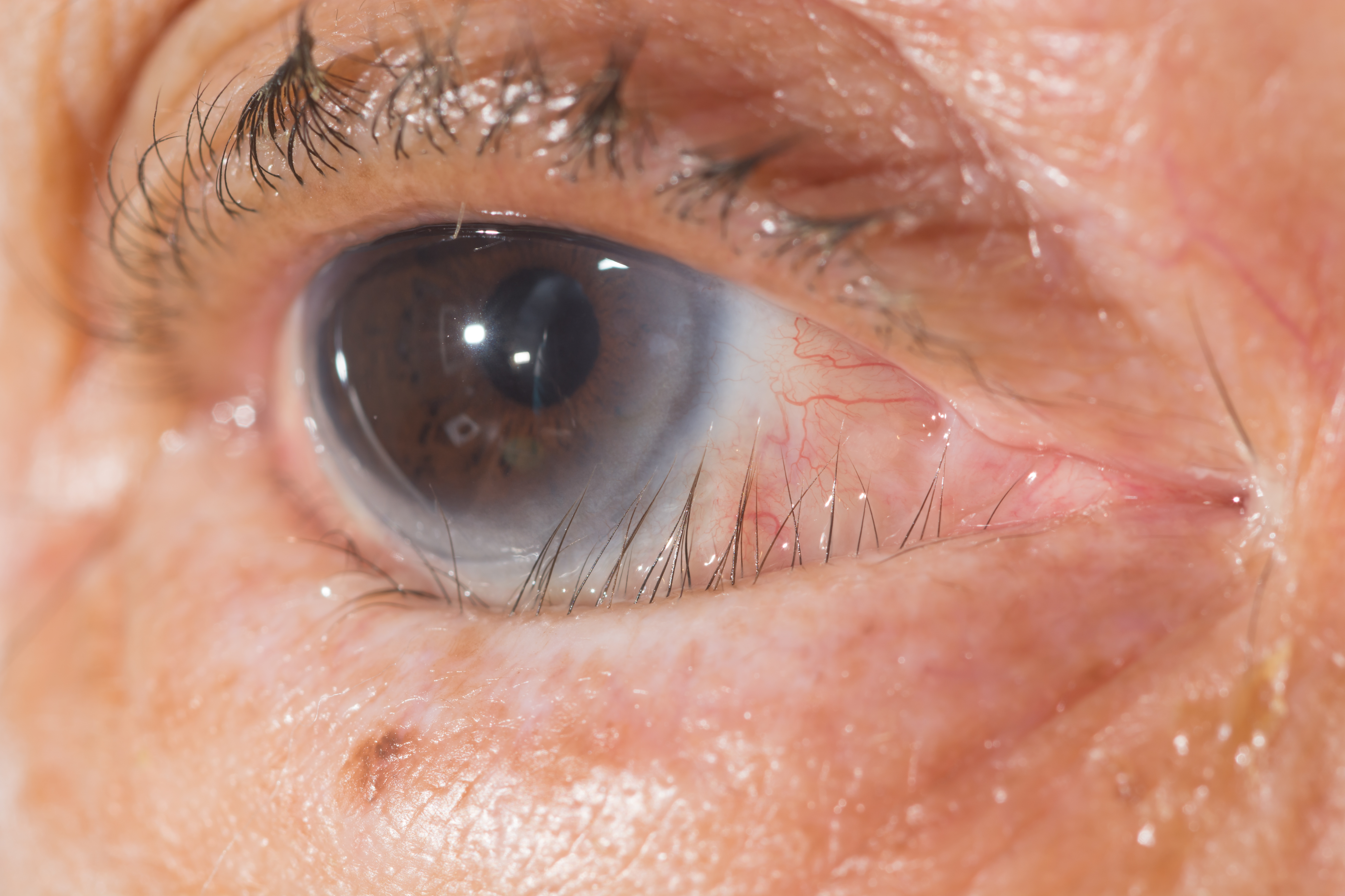 Trichiasis 